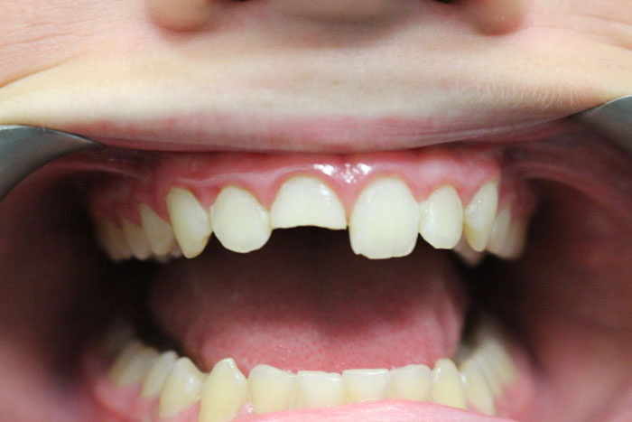 Bọc sứ cho trường hợp răng vỡ mẻ lớn
