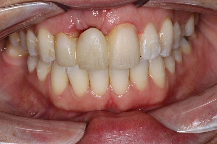 Cầu răng sứ không khắc phục được tình trạng tiêu xương hàm sau khi mất răng