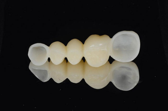 Cầu răng tạm trên Implant