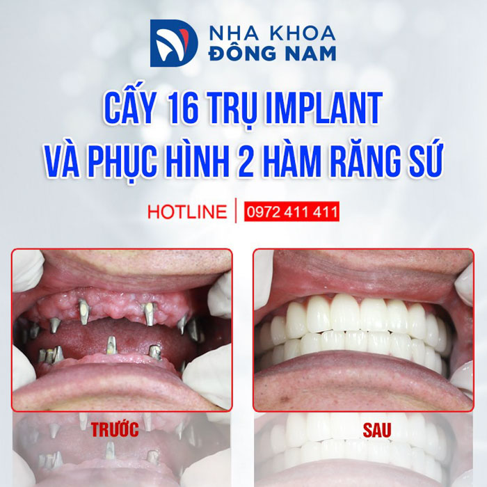 Cấy ghép Implant là phương pháp phục hình răng giả tốt nhất hiện nay