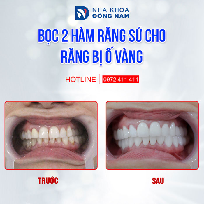 Chọn răng sứ phù hợp với gương mặt, màu da và màu mắt