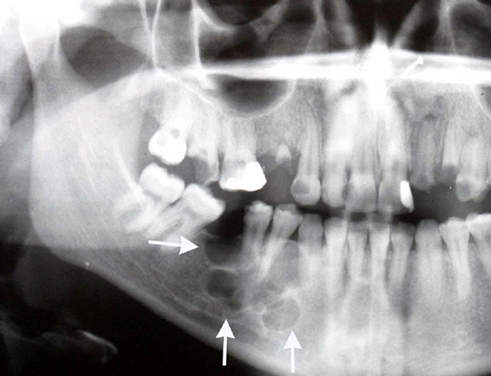 Chụp X-quang răng để chẩn đoán ung thư xương hàm