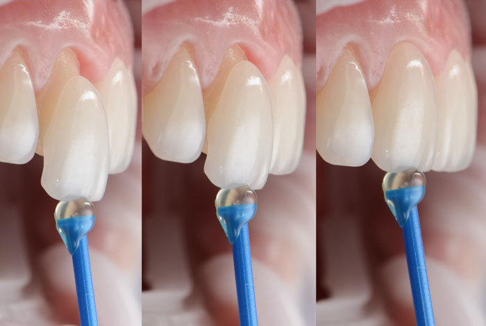 Dán răng sứ hạn chế tối đa việc phải mài chỉnh răng thật