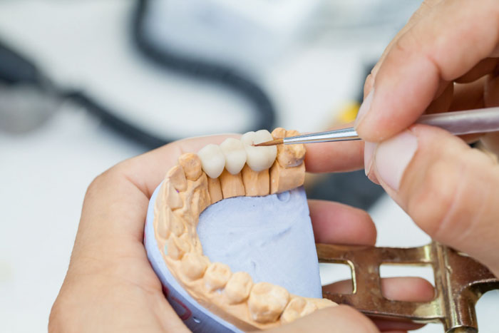 Điều chỉnh hoặc làm lại cầu răng sứ mới cho bệnh nhân