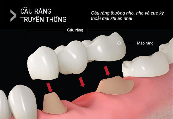 Hình ảnh mô phỏng cầu răng sứ truyền thống
