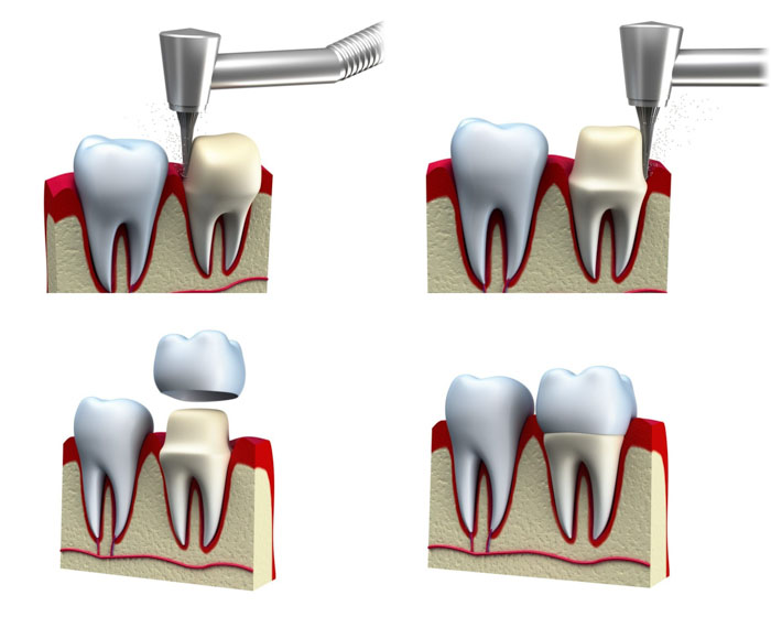 Hình ảnh mô phỏng kỹ thuật bọc răng sứ