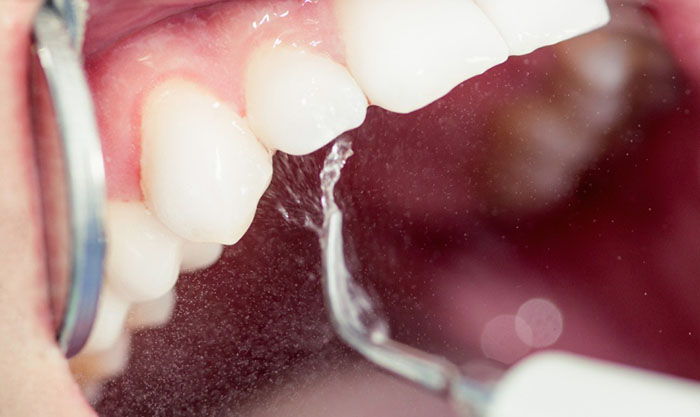 Lấy cao răng có đau không?