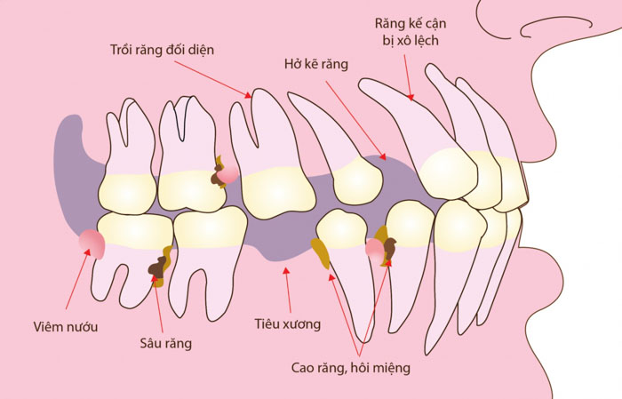 Mất răng gây ra nhiều biến chứng nguy hiểm