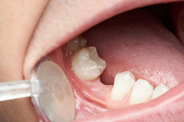 Mất răng lâu ngày bị tiêu xương hàm cần phải thực hiện cấy ghép thêm xương