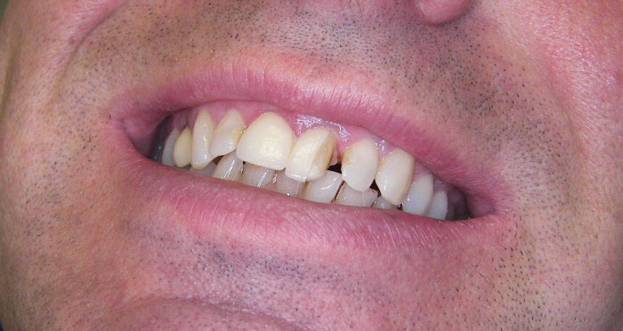 Răng giả kém chất lượng dễ vỡ mẻ