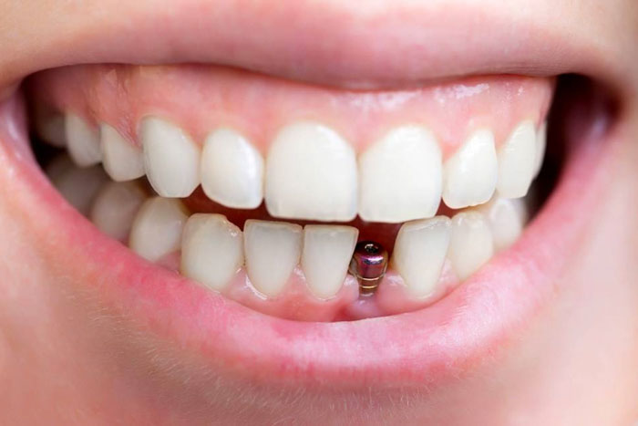Răng tạm trên Implant thường được chỉ định cho bệnh nhân mất răng cửa