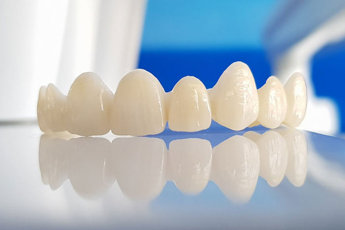 Răng toàn sứ cao cấp cho tuổi thọ cao hơn so với răng sứ kim loại
