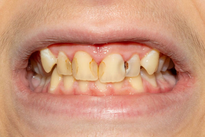 Răng viêm tủy bọc sứ giúp duy trì tuổi thọ được lâu hơn