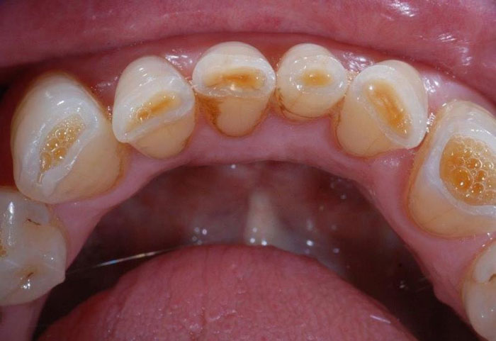 Tình trạng mòn men răng