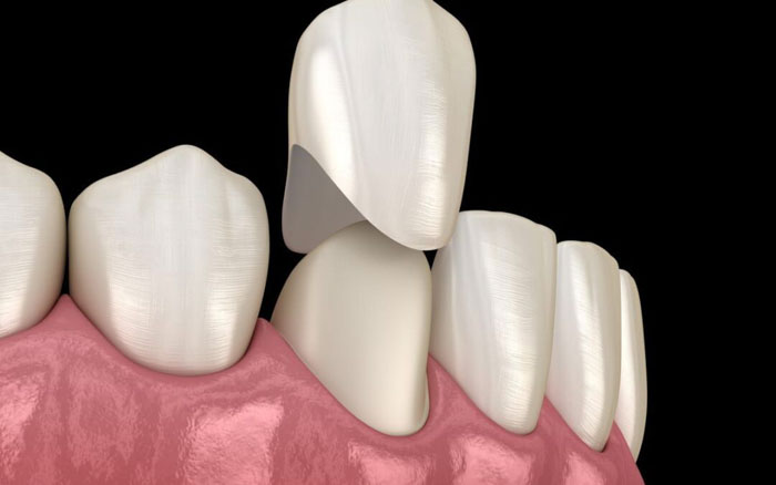 Trong thời gian chờ mão răng sứ hoàn thiện bệnh nhân sẽ được gắn răng tạm