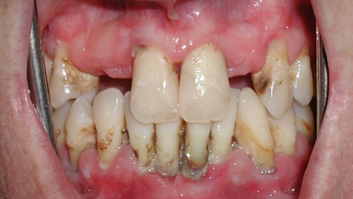 Bệnh lý răng miệng phát triển nặng sẽ có nguy cơ cao gây mất răng