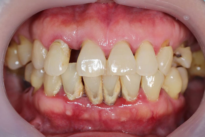 Bệnh nha chu rất dễ làm răng bị lung lay, thậm chí mất răng
