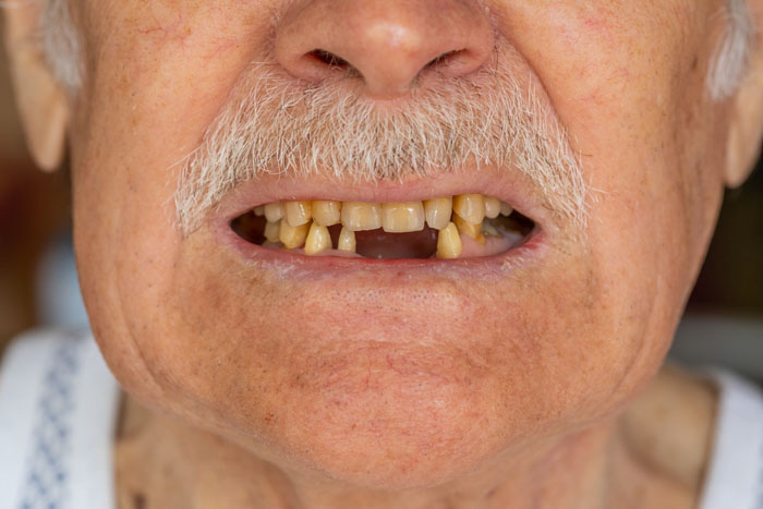 Càng lớn tuổi thì khó tránh khỏi nguy cơ răng bị gãy rụng