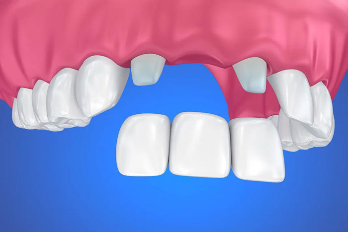 Cầu răng sứ cần mài răng bên cạnh răng mất để làm trụ