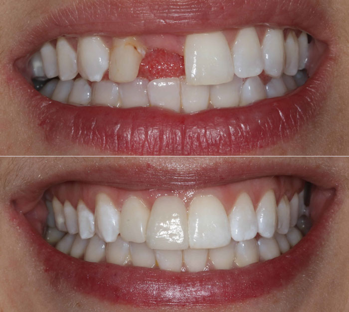 Cầu răng sứ răng cửa giúp khôi phục thẩm mỹ và ăn nhai