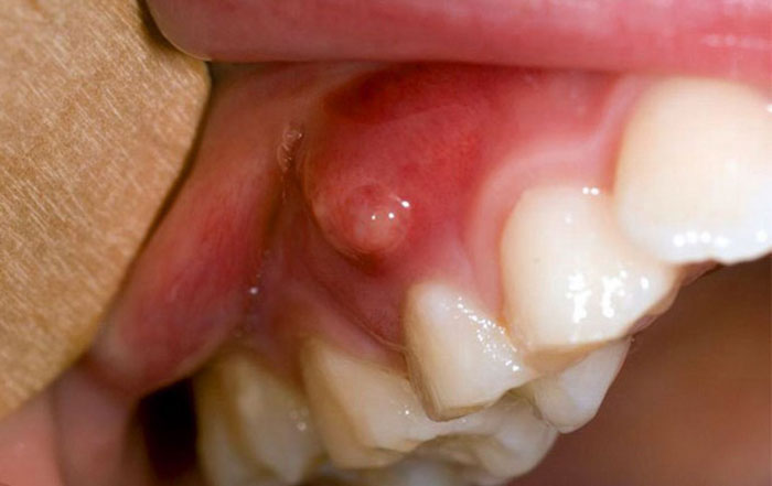 Chích thuốc tê với trường hợp tủy răng chưa bị hoại tử hoàn toàn