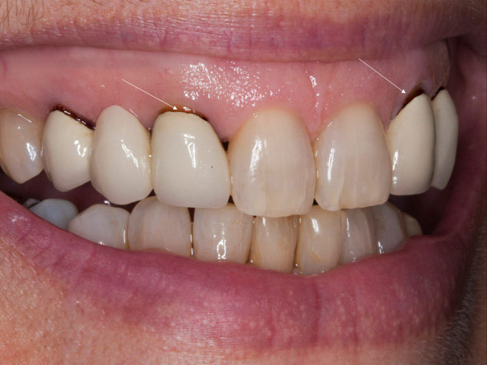 Đen viền nướu do dùng răng sứ kim loại