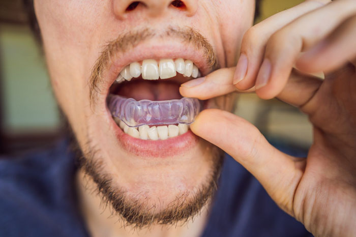 Đeo máng chống nghiến để bảo vệ răng tốt hơn