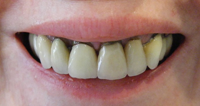 Dòng răng sứ kim loại dễ bị đen viền, đổi màu răng khi dùng được một thời gian