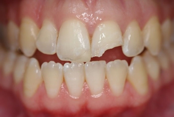 Gãy răng cửa có thể xảy ra ở 1 hoặc nhiều răng