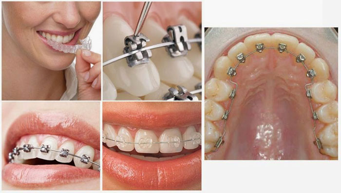 Khi răng mọc không đều nên niềng răng để khắc phục hiệu quả nhất