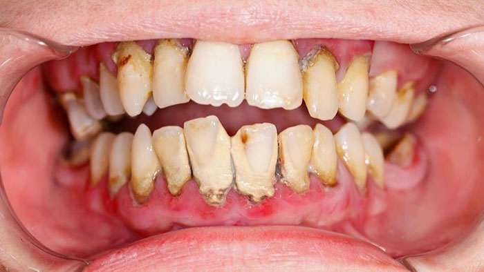 Lười chải răng rất dễ làm phát sinh nhiều bệnh lý ở răng miệng