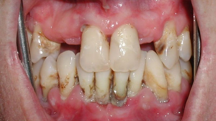 Mất răng dễ làm phát sinh nhiều bệnh lý khác ở răng miệng