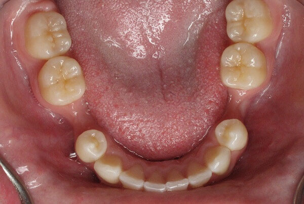 Mất răng lâu ngày gây tình trạng tiêu xương hàm làm nướu teo lại