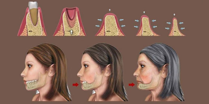 Mất răng tiêu xương hàm khiến gương mặt trở nên lão hóa
