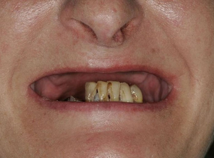 Mất răng toàn hàm có thể do nhiều nguyên nhân khác nhau gây nên