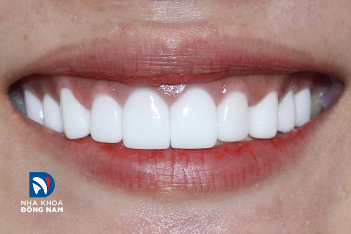 Màu răng sứ trắng đục đem lại thẩm mỹ khá tự nhiên cho hàm răng