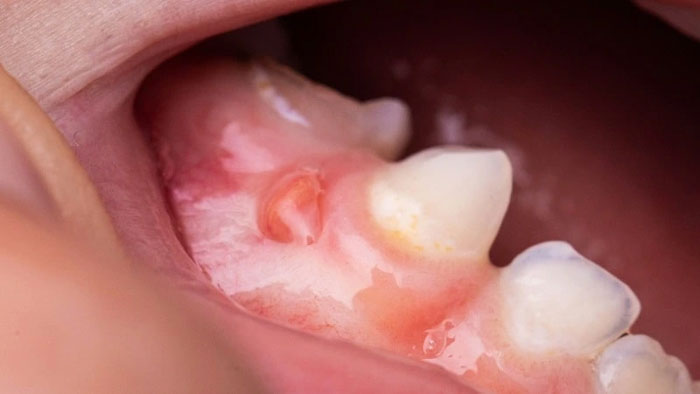 Nhiễm trùng răng hình thành ổ áp-xe