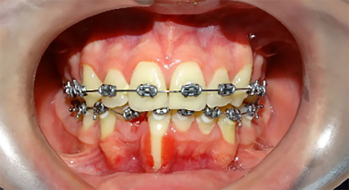 Niềng răng bị viêm lợi sẽ gây nhiều ảnh hưởng nguy hại
