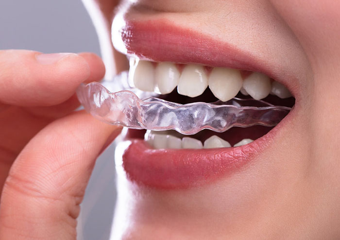 Niềng răng Invisalign tháo lắp thuận tiện