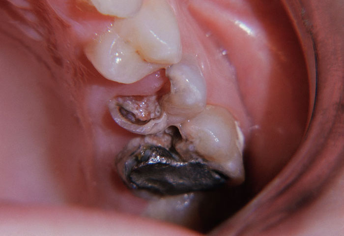Răng bị sâu lớn phá hủy nhiều mô răng