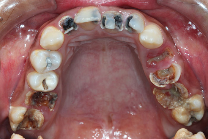 Răng bị tổn thương, gãy mẻ nghiêm trọng do bệnh lý ở răng
