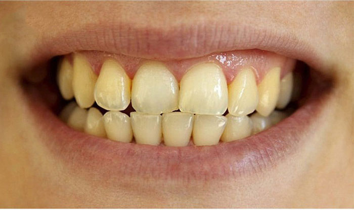 Răng có thể bị ố vàng nếu dùng nước súc miệng chứa chlorhexidine gluconate