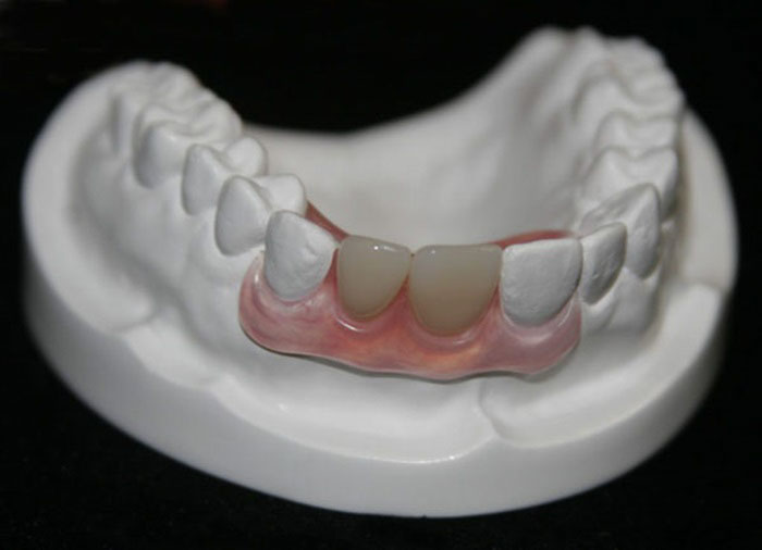 Răng giả tháo lắp chỉ đáp ứng ăn nhai ở mức trung bình