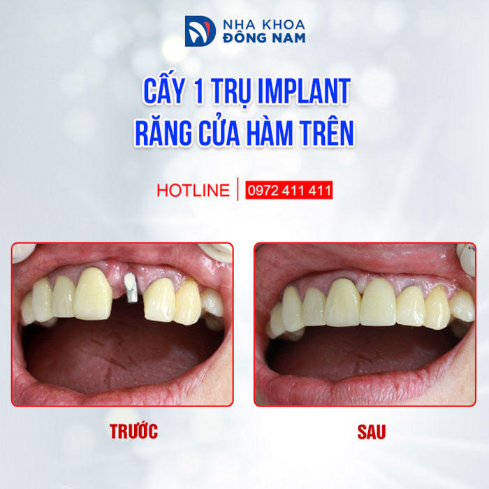 Răng Implant mang lại khả năng ăn nhai chắc chắn như răng thật