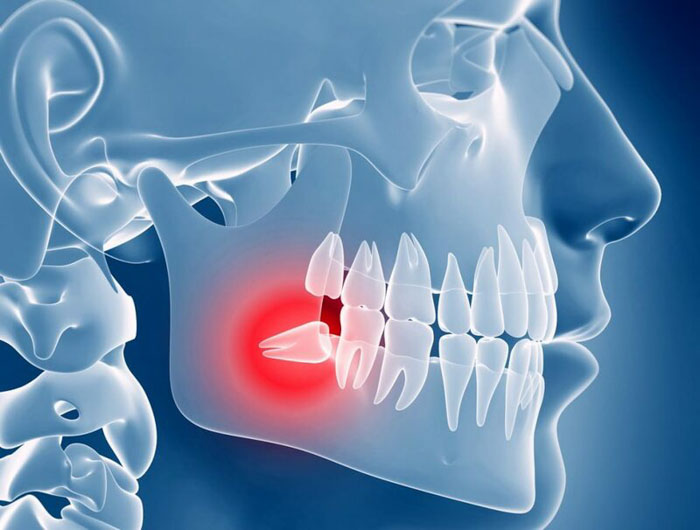 Răng khôn là chiếc răng mọc cuối cùng nằm sâu bên trong cung hàm