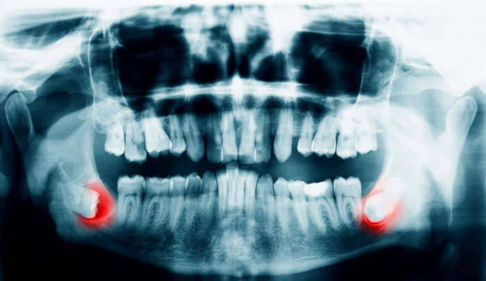 Răng khôn thường gặp tình trạng mọc lệch, mọc ngầm