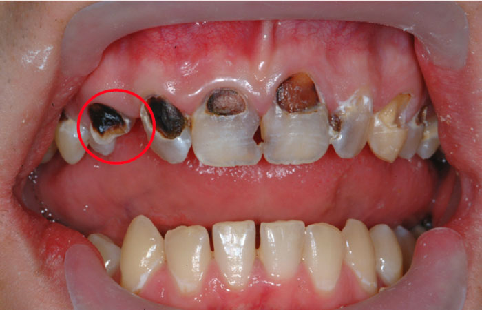Răng nanh cũng bị sâu răng nếu không được chăm sóc cẩn thận