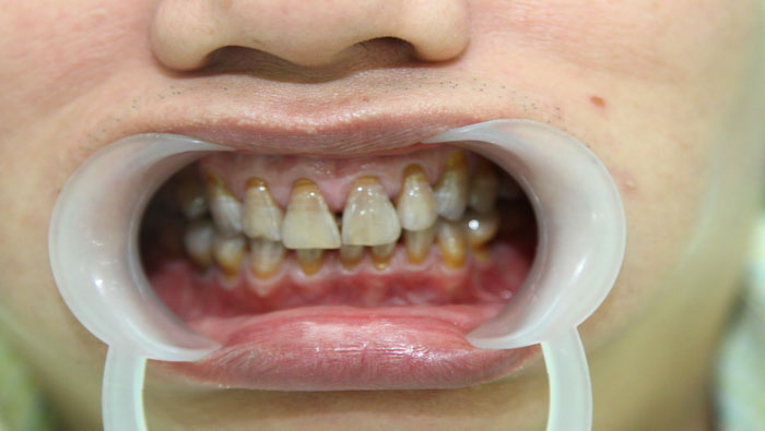 Răng ố vàng do nhiễm kháng sinh không thể khắc phục bằng việc đánh răng