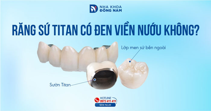 Răng sứ Titan có đen viền nướu không?
