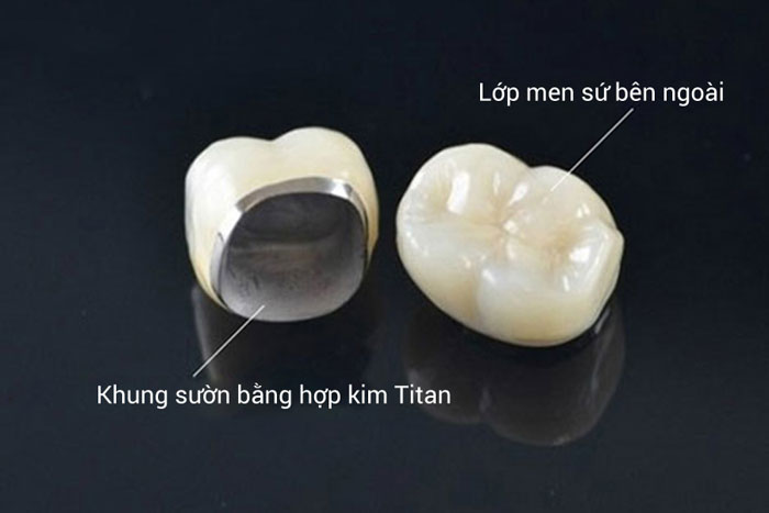Răng sứ Titan có khung sườn bằng hợp kim
